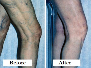 Spider vein treatment before and after pic
